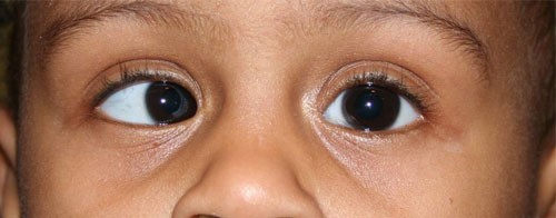  جراحی انواع انحرافات افقی و عمودی چشم و جراحی نیستاگموس